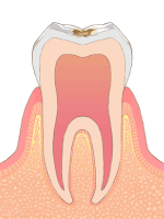 C1→虫歯の中期状態