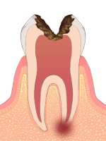 C3→虫歯の後期状態（後期）