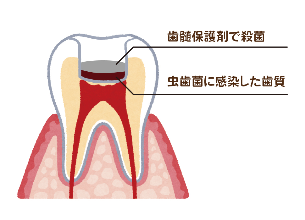 虫歯の治療 歯髄温存治療